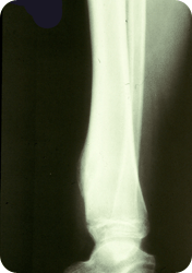 X-ray of tibia